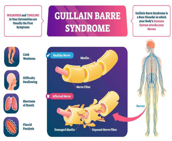 Illustration for Guillain-Barre Syndrome Overview (Autoimmune Disease)