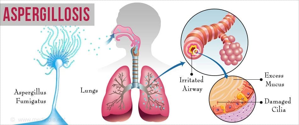 Illustration for Aspergillosis Fungal Respiratory Infection (Fungal Disease)