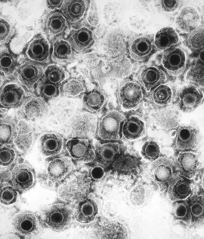 Transmission electron micrograph of herpes simplex virus particles, dozens of dark round virions each showing a dense core inside a capsid and a surrounding envelope