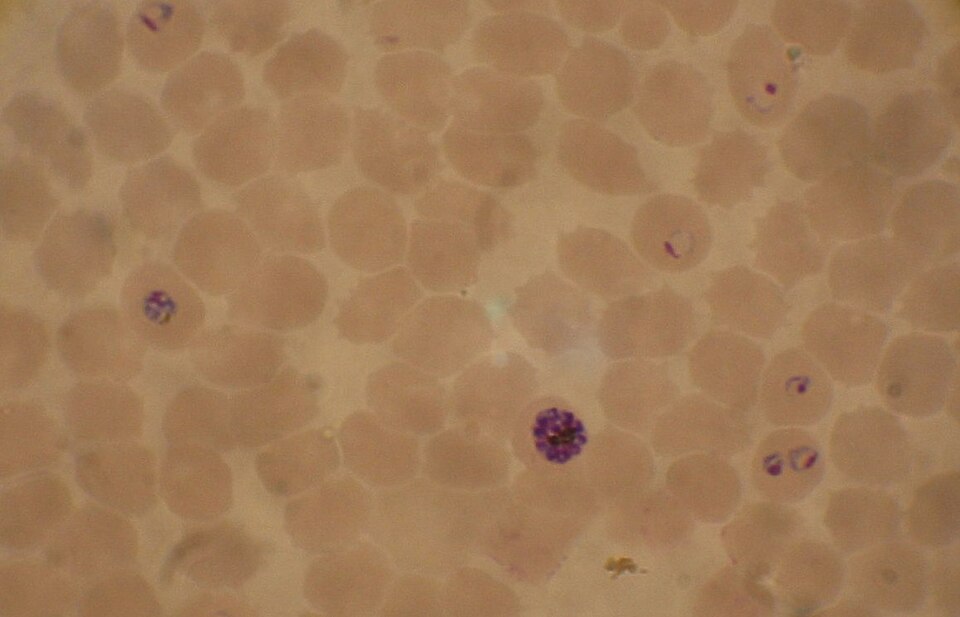 A stained blood film in which several red blood cells contain purple-stained Plasmodium falciparum parasites, including small ring forms and a dividing schizont.