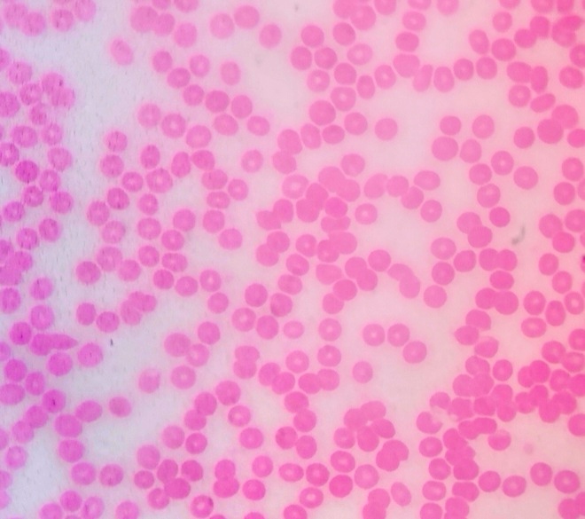 A stained human blood smear under the microscope, crowded with round pink red blood cells that each show a pale centre and no nucleus.