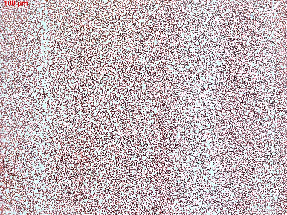 Human blood under the microscope, the field packed with red blood cells, with a 100 micrometre scale bar.
