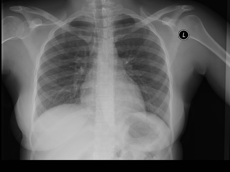 A normal chest X-ray radiograph showing the ribcage, lungs and heart