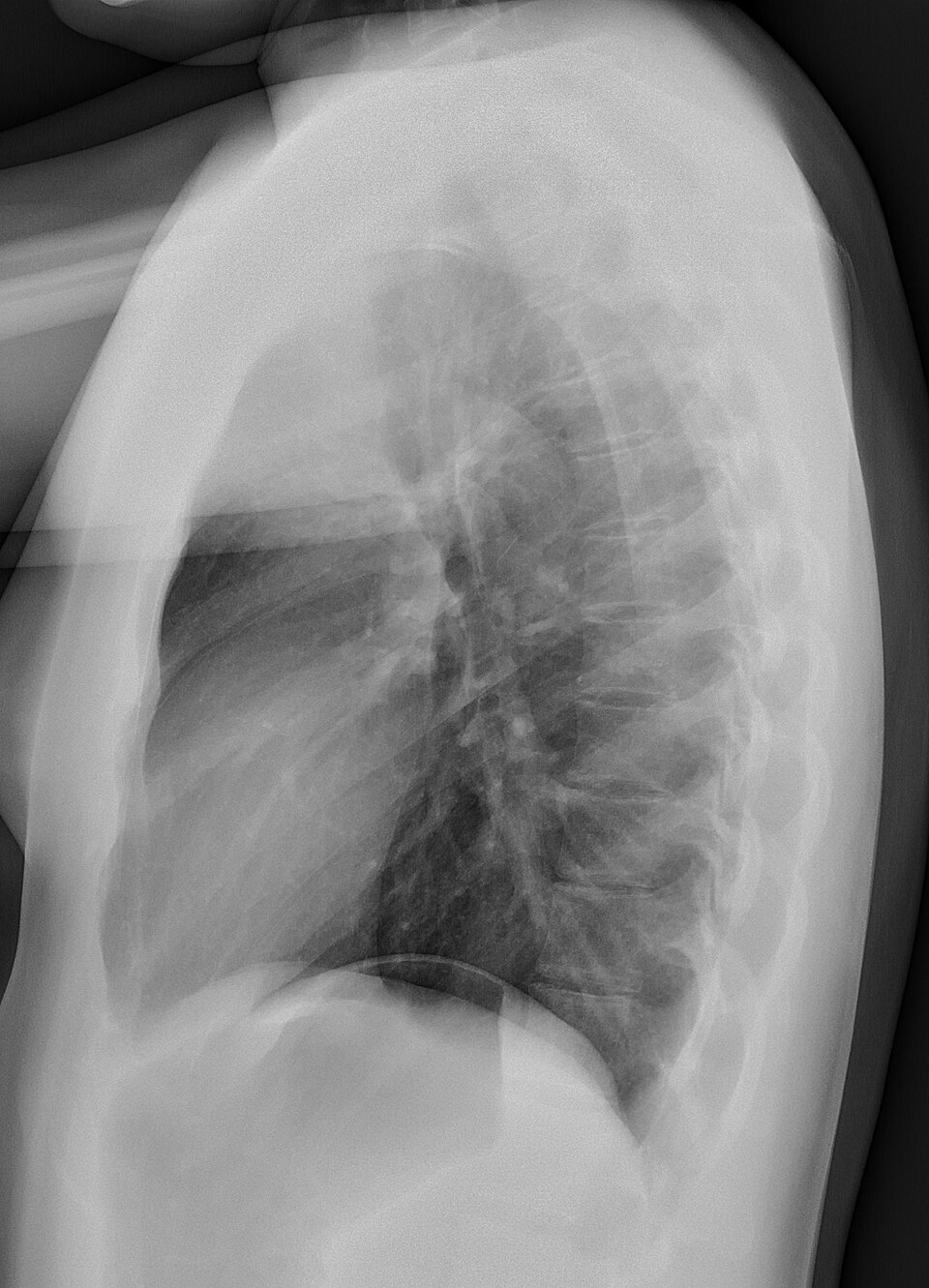 A plain chest X-ray taken from the side, showing the curving ribs, the spine and the dark air-filled lung fields above the dome of the diaphragm.
