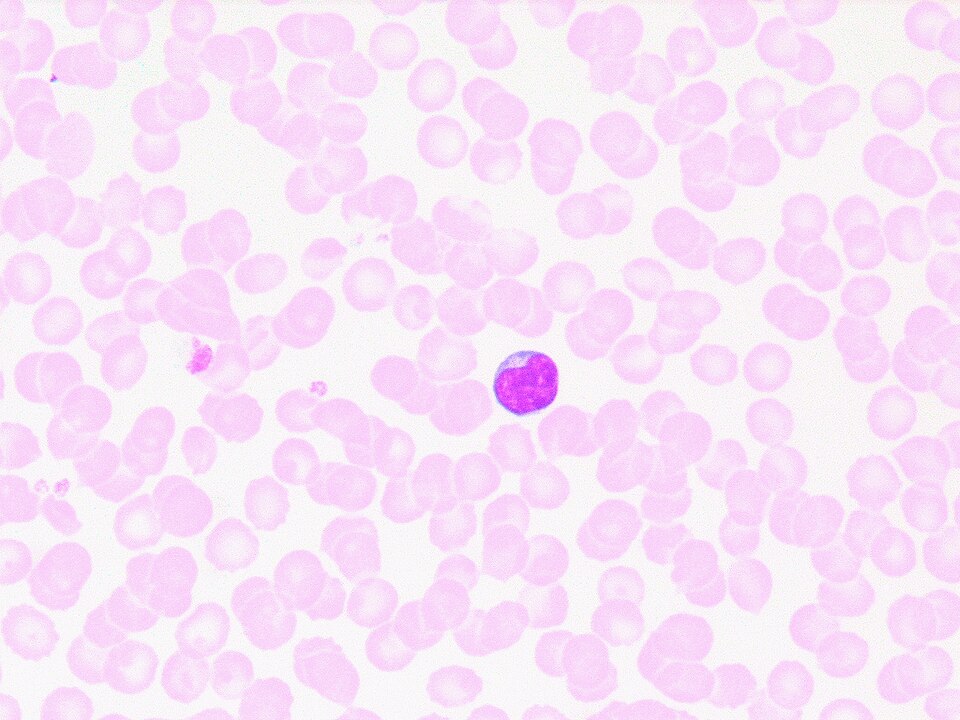 Stained blood smear showing a single lymphocyte with a dense purple nucleus among red blood cells