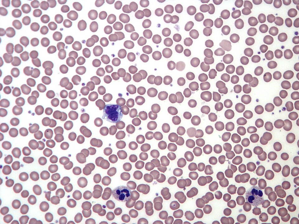A Wright-stained human blood smear under the microscope: many pale-pink red blood cells with a large purple-stained white blood cell (a lymphocyte) standing out among them