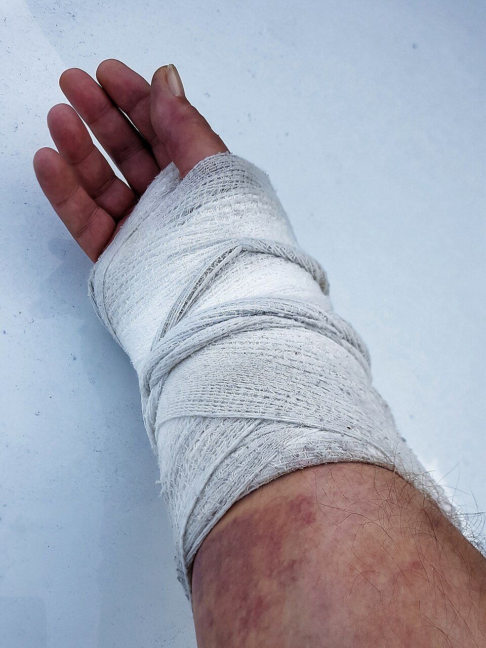 A hand and wrist in a white plaster-of-Paris cast (splint)