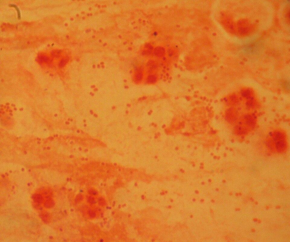 Gram-stained smear under the microscope showing dense clusters of tiny pink-red coccobacilli among stained host cells