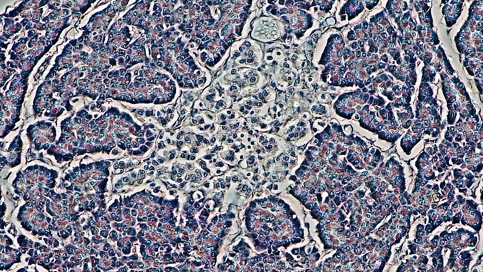 A stained microscope view of human pancreatic tissue showing a pale central cluster of islet cells (islet of Langerhans) surrounded by darker exocrine acinar tissue