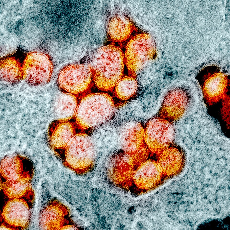 A colourised electron micrograph in which clusters of round orange-and-red SARS-CoV-2 virus particles sit on and emerge from the grey-blue surface of an infected cell