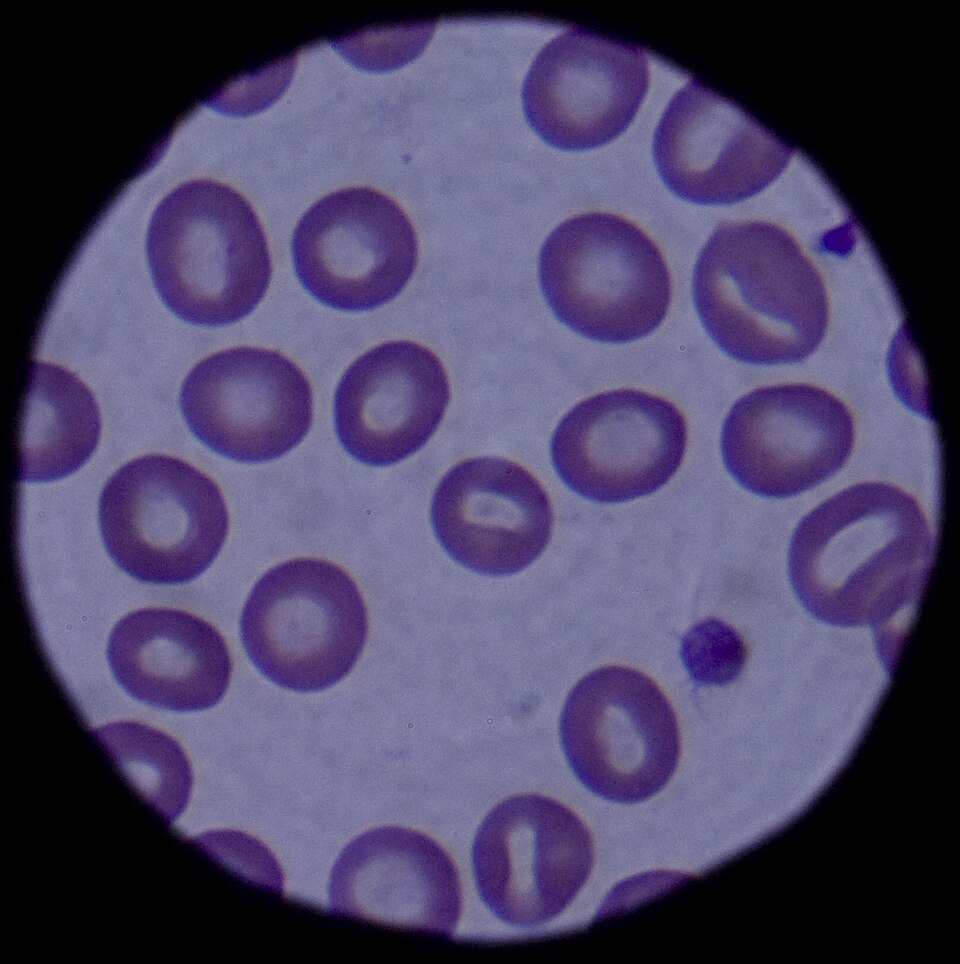 A stained human blood smear viewed down a light microscope, showing many pale-centred, doughnut-like red blood cells with a small darkly stained cell among them